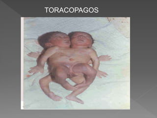 TORACOPAGOS
 