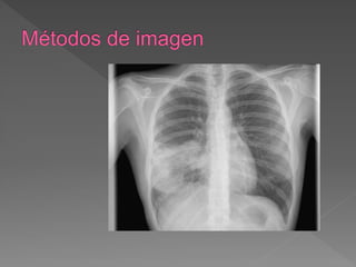  Sarcoma de Ewing pulmonar/tumor
neuroectodérmico
 
