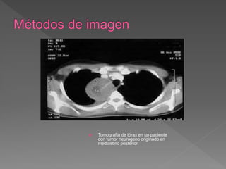  Tomografía de tórax en un paciente
con tumor neurógeno originado en
mediastino posterior
 