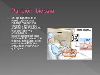  En los tumores de la
pared torácica está
indicado realizar una
citología o biopsia por
punción. Este método es
muy confiable y la
posibilidad de
diseminación local en el
trayecto de la punción es-
mínima, más aún si se lo
efectúa 24 a 48 horas
antes de la intervención
quirúrgica.
 