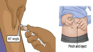 Comprehensive Guide to Parenteral Drug Administration: IM, IV, SC, and ...
