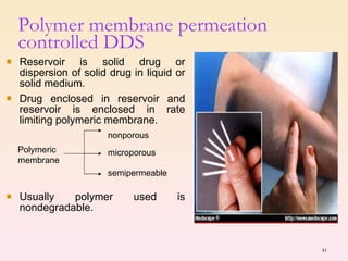 Reservoir is solid drug or dispersion of solid drug in liquid or solid medium. Drug enclosed in reservoir and reservoir is enclosed in rate limiting polymeric membrane. Usually polymer used is nondegradable. Polymer membrane permeation controlled DDS Polymeric membrane nonporous microporous semipermeable 