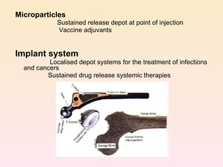 Microparticles Sustained release depot at point of injection  Vaccine adjuvants Implant system Localised depot systems for the treatment of infections  and cancers   Sustained drug release systemic therapies 