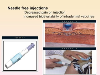 Needle free injections Decreased pain on injection  Increased bioavailability of intradermal vaccines 