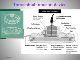 Intraspinal infusion device
6/15/2020
 