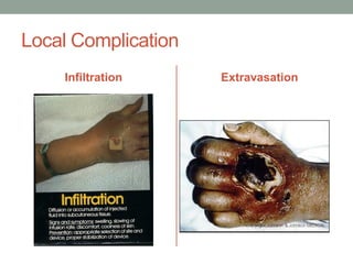 Local Complication
Infiltration Extravasation
 