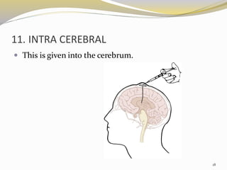 11. INTRA CEREBRAL
 This is given into the cerebrum.
18
 