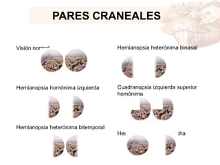PARES CRANEALES
Hemianopsia heterónima binasal
Cuadranopsia izquierda superior
homónima
Hemianopsia nasal derecha
Visión normal
Hemianopsia homónima izquierda
Hemianopsia heterónima bitemporal
 