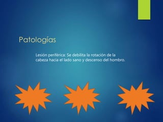 Lesión periférica: Se debilita la rotación de la
cabeza hacia el lado sano y descenso del hombro.
 