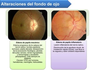 Alteraciones del fondo de ojo
Edema de papila mecánico
Edema progresivo de la cabeza del
nervio óptico: bordes papilares
borrosos; papila elevada; desaparición
de la excavación fisiológica; pérdida
del pulso venoso; venas ingurgitadas,
y hemorragias y exudados
peripapilares. Casi siempre es
bilateral.
Causas: HTIC por tumores,
hematomas, meningitis, hidrocefalia
Edema de papila inflamatorio
Lesión inflamatoria del nervio óptico.
Disminución de la agudeza visual, de
instalación rápida (horas), que lleva a
la ceguera y dolor orbitario espontáneo
 