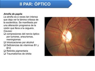 Atrofia de papila
La atrofia es a veces tan intensa
que deja ver la lámina cribosa de
la esclerótica. Se manifiesta por
una alteración progresiva de la
visión que lleva a la ceguera.
Causas:
 compresiones del nervio óptico
por tumores, aneurismas,
meningiomas
 Intoxicaciones por alcohol
 Deficiencias de vitaminas B1 y
B12
 Retinitis pigmentaria
 Traumatismos de órbita
II PAR: ÓPTICO
 
