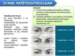 Causas:
1) Tronco del encéfalo (encefalitis, infartos,
tumores, enfermedades desmielinizantes,
traumatismos)
2) Trayecto periférico: secundaria a meningitis
tuberculosa, carcinomatosis meníngea,
tumores, neuropatía isquémica,
aneurismas, etc.
IV PAR: PATÉTICO/TROCLEAR
Parálisis del IV par
Es poco llamativa a la
inspección.
Imposibilidad de descender
el ojo aducido
Dificultad para bajar
escaleras (necesita poder
descender el ojo aducido
para tal fin).
Lesión nuclear = parálisis
de oblicuo mayor
contralateral
Lesión periférica = parálisis
homolateral
 