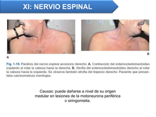 Causas: puede dañarse a nivel de su origen
medular en lesiones de la motoneurona periférica
o siringomielia.
XI: NERVIO ESPINAL
 