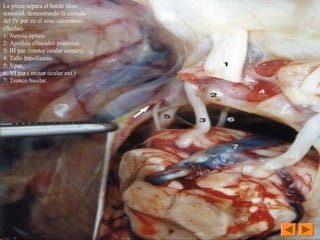 La pinza separa el borde libre 
tentorial, demostrando la entrada 
del IV par en el seno cavernoso 
(flecha). 
1: Nervio óptico. 
2: Apófisis clinoides posterior. 
3: III par. (motor ocular común)
4: Tallo hipofisario. 
5: Vpar. 
6: VI par ( motor ocular ext.)
7: Tronco basilar.
 