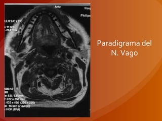 Paradigrama del
N. Vago
 