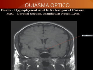 QUIASMA OPTICO
 