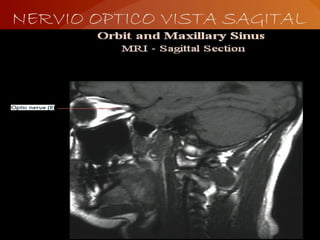NERVIO OPTICO VISTA SAGITAL
 