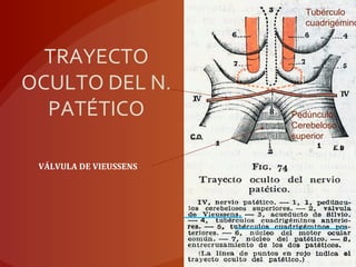 TRAYECTO
OCULTO DEL N.
PATÉTICO
VÁLVULA DE VIEUSSENS
Pedúnculo
Cerebeloso
superior
Tubérculo
cuadrigémino
 