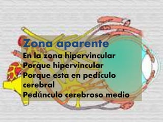 Zona aparente
En la zona hipervincular
Porque hipervincular
Porque esta en pedículo
cerebral
Pedúnculo cerebroso medio
 