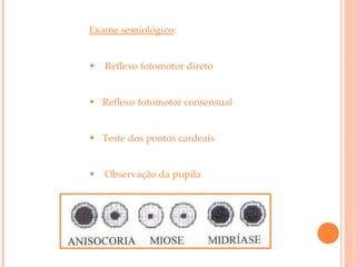 Exame semiológico : Reflexo fotomotor direto Reflexo fotomotor consensual Teste dos pontos cardeais Observação da pupila 