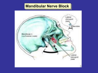 Mandibular Nerve Block  