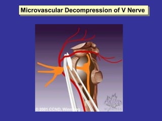 Microvascular Decompression of V Nerve  