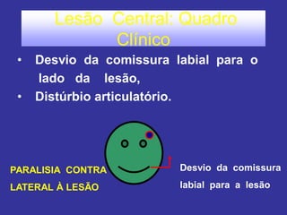 Lesão Central: Quadro Clínico 
• Desvio da comissura labial para o 
lado da lesão, 
• Distúrbio articulatório. 
PARALISIA CONTRA 
LATERAL À LESÃO 
Desvio da comissura 
labial para a lesão  