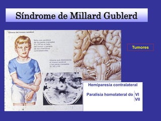 Hemiparesia contralateral 
Paralisia homolateral do VI 
VII 
Síndrome de Millard Gublerd 
Tumores  