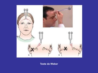 Teste de Weber 
 