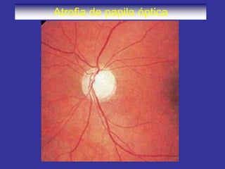 Atrofia de papila óptica  