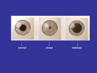 normal 
miose 
midríase  