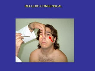 REFLEXO CONSENSUAL  