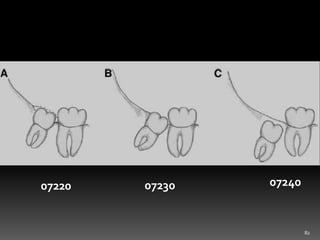 SURGICAL EXTRACTION OF MANDIBULAR THIRD MOLAR | PPTX