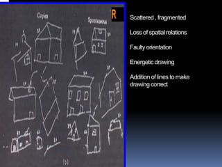            APRAXIA        Definition Difficulty in performing skilled motor acts which can not be explained by an elementary sensory or motor deficit or language comprehension disorder