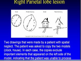 Apractic agraphia- agraphia despite normal  sensory, motor & visual feed back, word & letter knowledgeLesion- Dom sup parietal lobuleVisuo spatial agraphia-neglect of (U) side of paper in writingLesion -- (R) temp- parietal junction