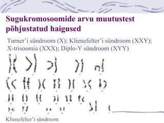 Sugukromosoomide arvu muutustest
põhjustatud haigused
Turner’i sündroom (X); Klienefelter’i sündroom (XXY);
X-trisoomia (XXX); Diplo-Y sündroom (XYY)
Klienefelter’i sündroom
 