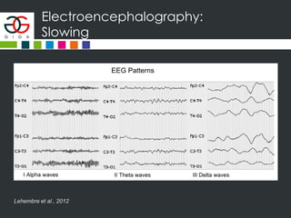 Electroencephalography:
Slowing
Lehembre et al., 2012
 
