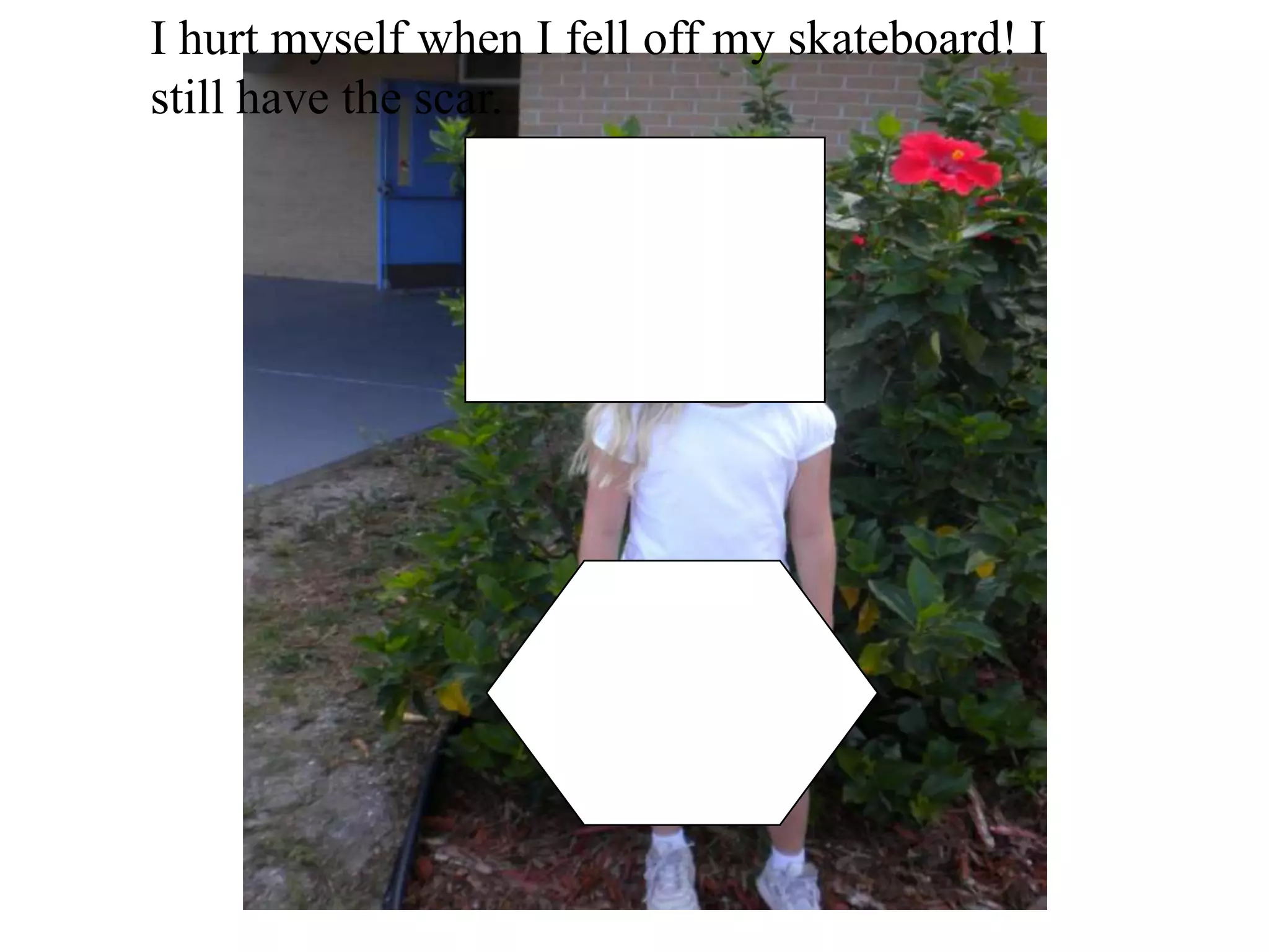 I hurt myself when I fell off my skateboard! I still have the scar.