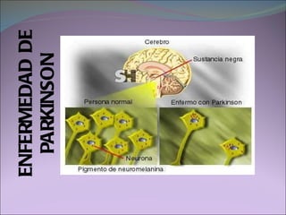 ENFERMEDAD DE PARKINSON 