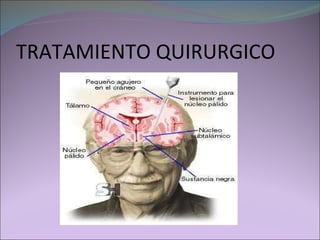 TRATAMIENTO QUIRURGICO 