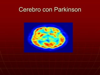 Cerebro con Parkinson
 