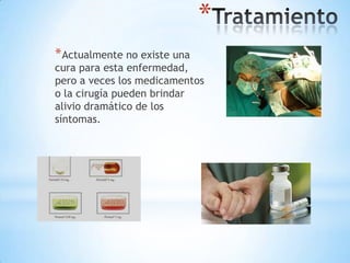 *
* Actualmente no existe una
cura para esta enfermedad,
pero a veces los medicamentos
o la cirugía pueden brindar
alivio dramático de los
síntomas.
 