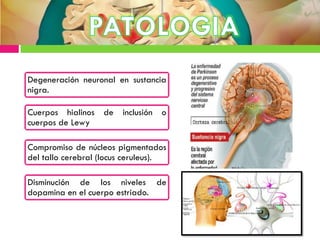 Degeneración neuronal en sustancia
nigra.
Cuerpos hialinos de inclusión o
cuerpos de Lewy
Compromiso de núcleos pigmentados
del tallo cerebral (locus ceruleus).
Disminución de los niveles de
dopamina en el cuerpo estriado.
 