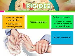 Primero en músculos
proximales
• cuello, tronco,
hombros, cadera.
Músculos distales
Todos los músculos
• Mayor en nuca,
tronco, flexores de
extremidades.
«Rueda dentada»
 