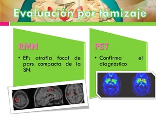 RMN
• EP: atrofia focal de
pars compacta de la
SN.
PET
• Confirma el
diagnóstico
 