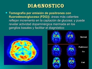 DIAGNOSTICODIAGNOSTICO
 Tomografía por emisión de positrones conTomografía por emisión de positrones con
fluorodesoxiglucosa (FDG)]:fluorodesoxiglucosa (FDG)]: áreas más calientesáreas más calientes
reflejan incremento en la captación de glucosa; y puedereflejan incremento en la captación de glucosa; y puede
revelar actividad dopaminérgica mermada en losrevelar actividad dopaminérgica mermada en los
ganglios basales y facilitar el diagnósticoganglios basales y facilitar el diagnóstico
 