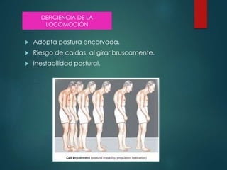  Adopta postura encorvada.
 Riesgo de caídas, al girar bruscamente.
 Inestabilidad postural.
DEFICIENCIA DE LA
LOCOMOCIÓN
 