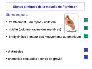 Signes cliniques de la maladie de Parkinson
Signes majeurs:
• tremblement : au repos - unilatéral
• rigidité (colonne; racine des membres)
• bradykinésie : lenteur des mouvements automatiques
• diskinésies
• anomalies posturales : centre de gravité
‘rolling-pill’
 