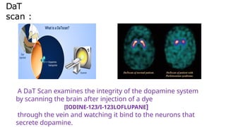 Comprehensive Overview of Parkinson's Disease: Symptoms, Diagnosis, and ...