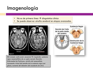 Imagenología
•  No es de primera línea à diagnóstico clínico
•  Se puede observar atrofia cerebral en etapas avanzadas.
RM craneal, corte axial, secuencia T2. Izquierda: sustancia
nigra mesencefálica de un sujeto normal. Derecha:
Enfermedad de Parkinson, atrofia del mesencéfalo,
incremento virtual del tamaño de la sustancia nigra por
gliosis, aumento del diámetro del acueducto de silvio
 